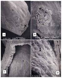 They fall under the general category of renal adenomas. Human Renal Papilla With Randall S Plug A Caox Stone S Surface Is Download Scientific Diagram