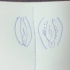 Aber die erste frage, die kommt uns in den sinn, wenn sie auftreten. Kleine Blaschen An Vagina Hilfe Gesundheit Und Medizin Liebe Sex