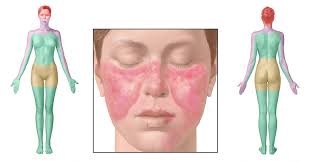 الذئبة الحمراء أو ذئبة حمامية مجموعية (بالإنجليزية: Ø§ÙØ¹ÙØ§Ø¬Ø§Øª Ø§ÙÙÙØ²ÙÙØ© ÙÙØ±Ø¶ Ø§ÙØ°Ø¦Ø¨Ø© Ø§ÙØ­ÙØ±Ø§Ø¡ Ø«ÙÙ ÙÙØ³Ù