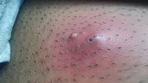 The bumps with the hair shaft in center are seen, close to the hair follicle opening on the shaved area. Ingrown Hair On Penis Get Rid Remove Bumps On Penile Shaft Base Treat Male Groin Area Ingrown Hair