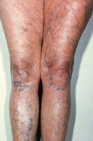 Éruption, des symptômes semblables à ceux de la grippe, fièvre, frissons, malaise, enflure des ganglions lymphatiques, mal de tête, torticolis. Symptomes Des Maladies Vectorielles A Tiques Mvt Media Tiques