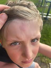 Has this happened to other gym girls? Neck injury from weight bar