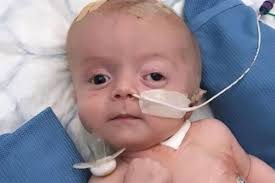 How to tell a child that a parent has cancer the child's age is important in deciding what and how much you should tell about a cancer diagnosis. Four Week Old Baby S Feeding Problems Were Signs Of Huge Brain Tumour Mirror Online