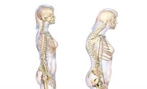 Maybe you would like to learn more about one of these? Kyphosis Cara Betulkan Tulang Belakang Bongkok My Rehab Spa