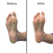 How to remove dry skin from your feet and legs: Effortlessly Eliminate Unsightly Corns And Calluses From Your Hands And Feet With The Corn Callu Hard Skin Remover Dry Skin On Face Organic Skin Care Routine