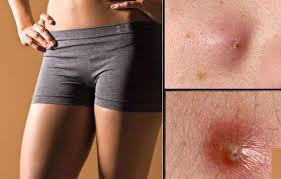 There Are A Few Among Us That Have Boils On Our Thighs And Buttocks And This Article Shows Us How To Get Rid Of Bo Inner Thigh Boils Get Rid Of