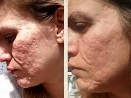 The technique involves using multiple tiny, sterile needles to puncture the skin and cause physical trauma. Dermaroller Fur Gesicht Falten Und Akne Mikronadeln