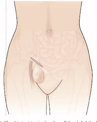 Sintomas De Hernia Inguinal Y Femoral Causas Y Tratamiento Cega