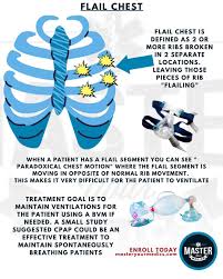 Image result for Flail Chest