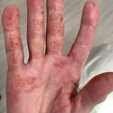 Image result for contact dermatitis