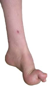 But the disease generally progresses slowly, and it doesn't affect expected life span. Hereditary Motor Sensory Neuropathies Charcot Marie Tooth