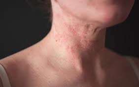 Image result for Atopic Dermatitis