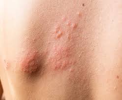Image result for skin rash acute hiv infection