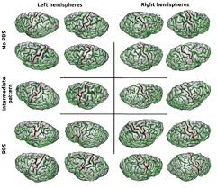 Automatic recognition of specific local cortical folding patterns