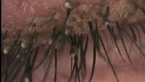 Image result for pubic lice