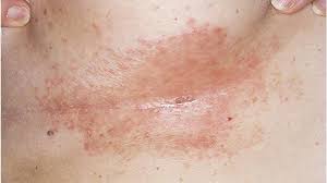 These areas are more susceptible to irritation and subsequent infection due to factors that promote skin breakdown such as moisture, friction, and exposure to bodily secretions such as sweat, urine, or feces. Natural Remedies For Intertrigo Candida Of The Skin Folds Youtube
