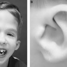 Composite Of 30 Patients Evaluated For Fg Syndrome Fgs A Definite Download Scientific Diagram