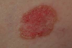 Skin infection often looks like a spider bite, with a painful, raised, red pimple that may drain pus needs to be treated with powerful antibiotics and can lead to more dangerous conditions like. Skin And Beauty Advice From The Dermatologist Beware Of The Stubborn Rash It Could Be Skin Cancer
