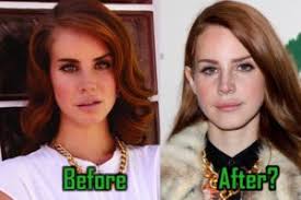 Lana del ray before and after . Celebritysurgeryicon Page 22 Of 22 Celebrity Plastic Surgery News Rumors Before And After Photos
