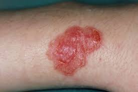 Image result for scabies human bites