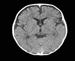 Radiation therapy radiation therapy is the most common treatment for children with brain stem glioma. Radiation From Ct Scans Can Increase Risk Of Brain Cancer In Children
