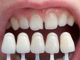 People with severly crowded teeth the process is the same for all of our products. How Long Do Porcelain Veneers Last Wilkinson Dental