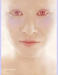 Albino Wow Albino Model Albinism Albino