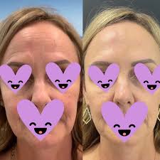 Michelle Huseman RN (@michellehuseman_aestheticsrn) • Instagram photos and  videos