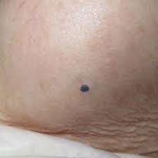 Image result for Blue Nevus