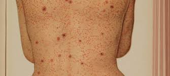 Image result for Syphilis