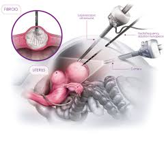 Image result for Radiofrequency Surgery