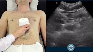 Using Ultrasound To Assess For An Abdominal Aortic Aneurysm