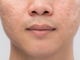 How to get rid of acne. How To Treat Acne Scars