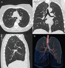 Parenchyma the parenchyma of the pineal body is comprised of lobules with a definite cytoarchitectural pattern and surrounded by connective tissue septa (fig. Lung Parenchyma Density And Airwall Thickness In Airway Diseases European Respiratory Society