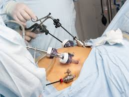 The result is a sleeve or tube like structure. Bariatric Surgery Preparation Recovery Long Term Care