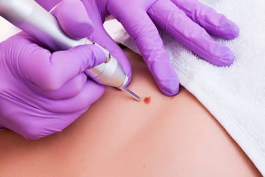 Skin Tag Removal in Dubai | drypSKin
