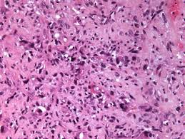 Les cancers de la thyroïde proviennent des cellules de la glande thyroïde. Cancers Anaplasiques De La Thyroide Sciencedirect