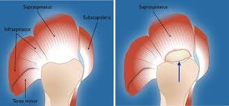 The subacromial bursa lies on the superior aspect of the supraspinatus tendon (see the images below). Rotator Cuff Tears Orthoinfo Aaos