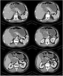 The chest ct assessments during admission revealed marked pleural effusion. Primary Sarcomatoid Malignant Mesothelioma Of The Pancreas Springerlink