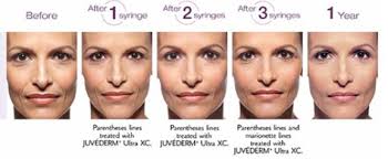 Botox and dermal fillers before and after photos. Juvederm Huntsville Al Plastic Surgery Brenda Edmonson Md