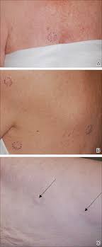 It's often spread throughout the breast or it may only show up as a sign of inflammation (such as. Diffuse Cutaneous Breast Cancer Metastases Resembling Subcutaneous Nodules With No Surface Changes Mdedge Dermatology