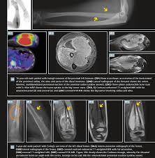 Subjects with benign and malignant bone lesions were compared. Pdf Benign And Malignant Bone Tumors Radiological Diagnosis And Imaging Features Semantic Scholar