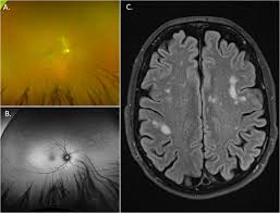 Image result for Neurosyphilis