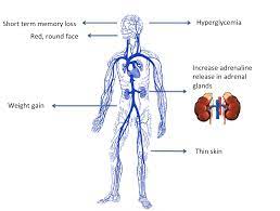 Difference Between Cushing S Disease And Cushing S Syndrome Difference Between