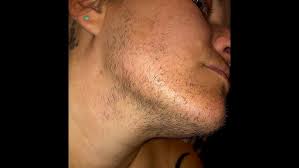 Image result for Hypertrichosis