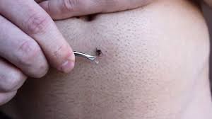 Belly button is a colloquial term used for what we all know as umbilicus or navel. Videogram Longest Ingrown Hair Removal Below Belly Button