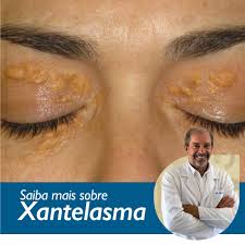 Image result for xantelasma