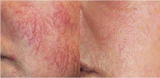 It helps to reduce their appearance. How To Get Rid Of Spider Veins On Your Face Connsense Bullet In