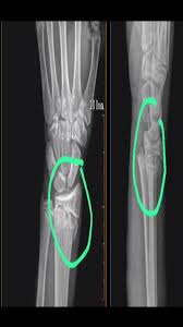 Image result for Hand Growth Plates