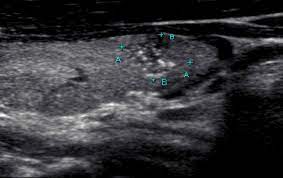 Diagnostic accuracy of microcalcification and other various signs seen in us scans for predicting malignancy was evaluated prospectively in 259 pathologically verified thyroid nodules. Pin On Ecografia De Cuello